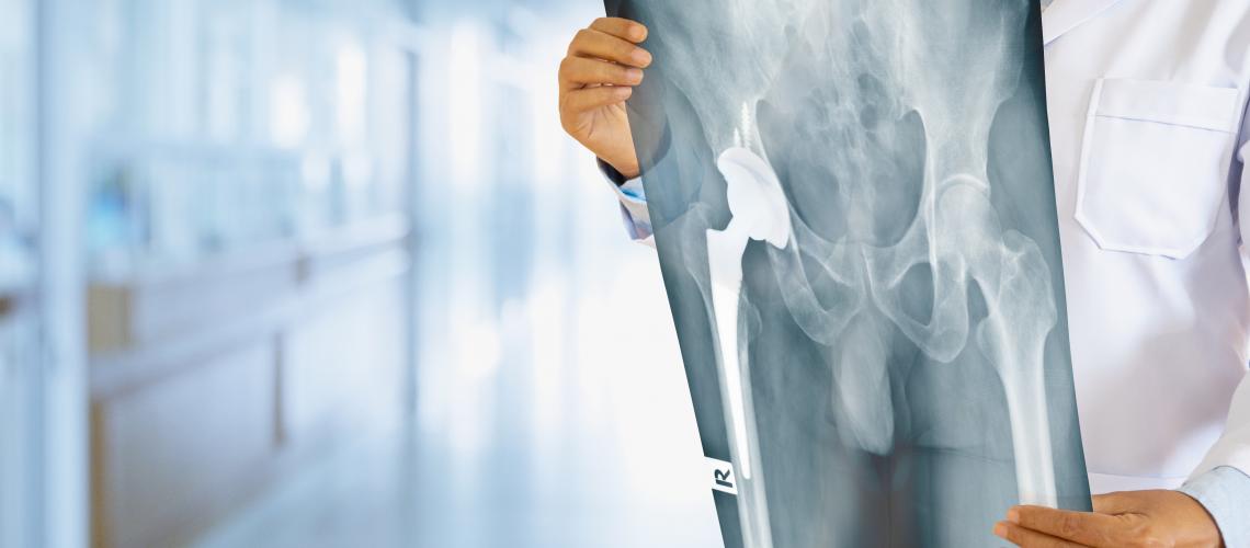 Osteoporose é uma doença silenciosa que atinge cerca de 10 milhões de pessoas no Brasil