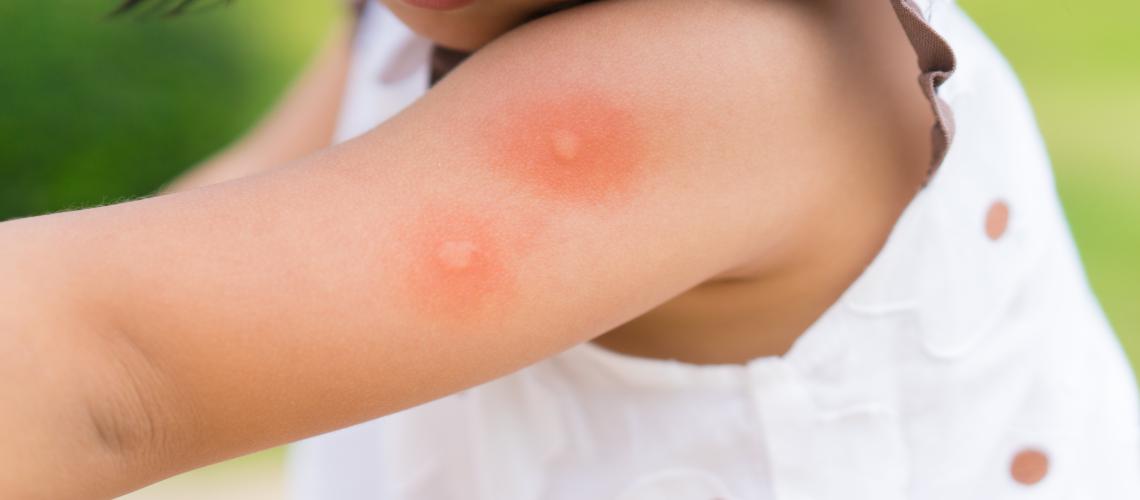 Casos de alergia a insetos aumentam no inverno e imunologista explica como evitar complicações à saúde